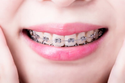 correct your bite at Summit Smiles in Rowland Heights