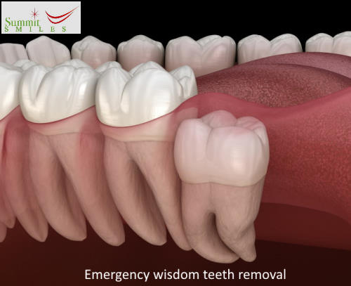 Emergency wisdom teeth removal in La Habra