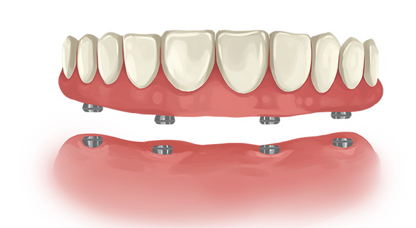 Lower Denture Implants Cost  