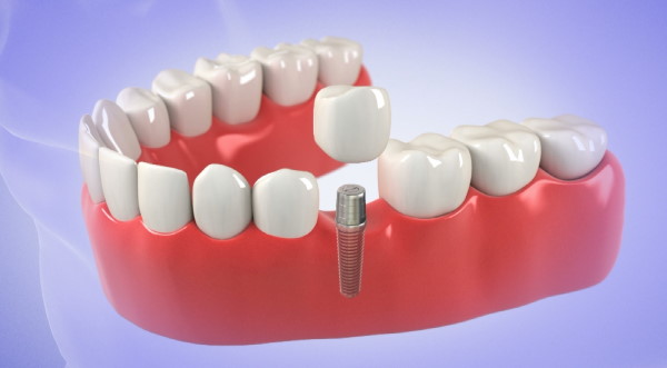 Are Same Day Dental Implants Safe?