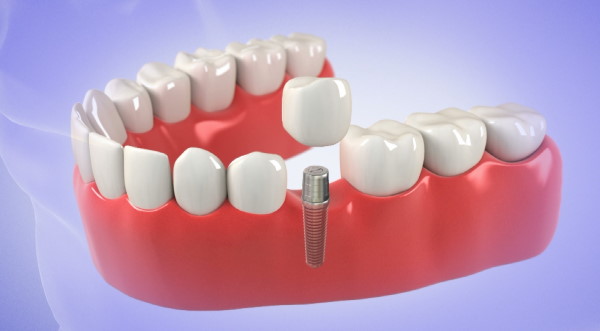 Same day dental implant - Immediate, One day, Cost, Best - , | -