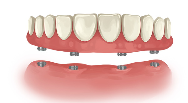 Implant bridge for La Habra community