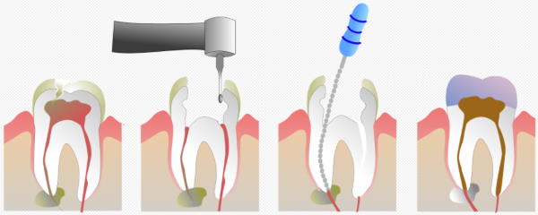 Endodontic treatment Orange County
