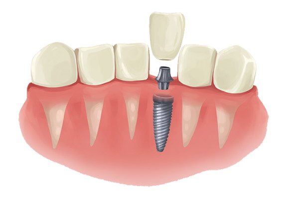 Price of one Dental Implant