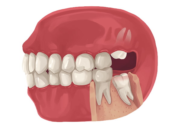 Is fever normal after wisdom tooth removal